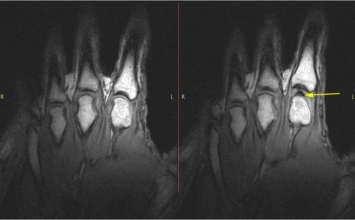Khoa học đã chứng minh tác hại khôn lường của tật bẻ khớp ngón tay