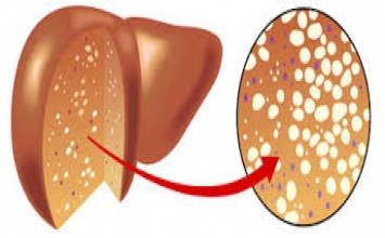Gan nhiễm mỡ có nguy hiểm không?