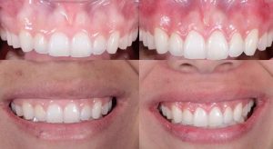 The Role Of Periodontists In Dental Implant Placement In Newtown, PA 1 The Role Of Periodontists In Dental Implant Placement In Newtown, PA