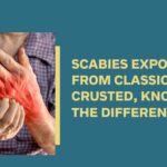 Scabies in Adults: Proven Medications That Work