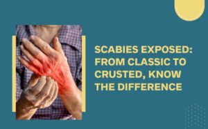 Scabies in Adults: Proven Medications That Work 1 Scabies in Adults: Proven Medications That Work