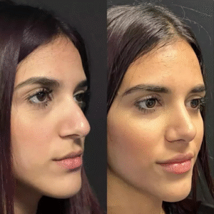 Choosing the Best Rhinoplasty Surgeon in Dubai for Ethnic Rhinoplasty 1 Choosing the Best Rhinoplasty Surgeon in Dubai for Ethnic Rhinoplasty