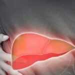 Fatty Liver: Difference Between Grade 1 and Grade 2 Explained 3 Fatty Liver: Difference Between Grade 1 and Grade 2 Explained