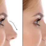 The Best Septoplasty Surgeon in Dubai: Where Skill Meets Compassion