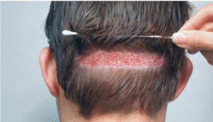 hybrid hair transplant 1 hybrid hair transplant