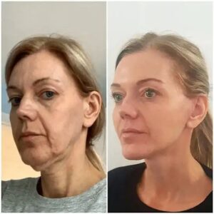 Experience Glow: Best Aesthetic Clinics in dubai Profhilo