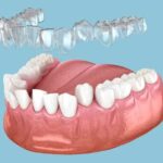 Transforming Underbites with Invisalign in Southampton