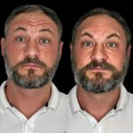 Timeless Beauty Elegance through Profhilo and Best Doctors in dubai 3 Timeless Beauty Elegance through Profhilo and Best Doctors in dubai