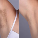 H15 Laser Hair Removal 1 1