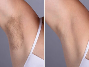 Best Doctors in Dubai for Laser Hair Removal: Quick, Painless, and Effective