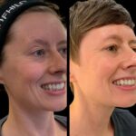 Adorn Skin Smooth Beauty with the Profhilo by Best Plastic Surgeons in dubai