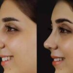 Best Septoplasty Surgeons in Dubai: Specialists in Septum Deviation