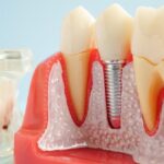 The Future of Painless Dentistry: Innovations You Need to Know