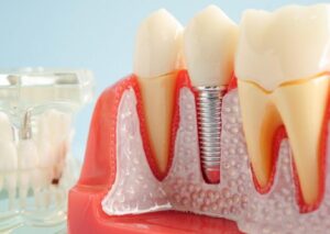 The Future of Painless Dentistry: Innovations You Need to Know