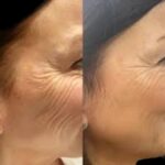Aim Higher using Profhilo at the Best Aesthetic Clinic in dubai