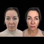 Polish Skin Elegance with Profhilo by Best Plastic Surgeons in dubai