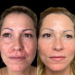 True Profhilo Care by the Best Plastic Surgeon in dubai Reserve