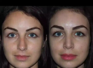 Discover the Best Doctors in Dubai Offering Septoplasty with Excellence