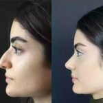 Best Doctors in Dubai: Redefining Facial Harmony Through Rhinoplasty 3 Best Doctors in Dubai: Redefining Facial Harmony Through Rhinoplasty
