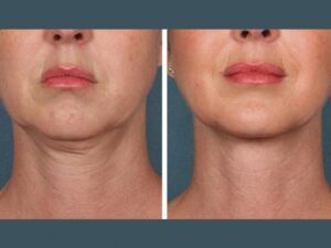 Best Doctors in Dubai for PRP Treatment: Solutions for Hair Thinning 1 Best Doctors in Dubai for PRP Treatment: Solutions for Hair Thinning