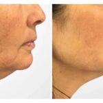 Achieve Sculpted Contours with Thread Lift at the Best Aesthetic Clinic in Dubai 3 Achieve Sculpted Contours with Thread Lift at the Best Aesthetic Clinic in Dubai