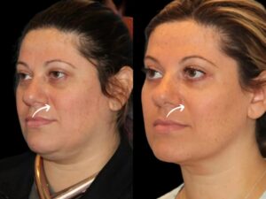 Sculptra Fillers in Dubai: Sustainable Beauty Trend