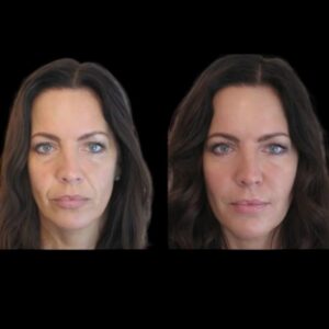 Jawline Fillers in Dubai: How the Treatment Works for Different Age Groups