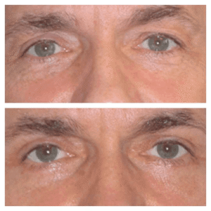 Fat Removal Under Eyes – Best Doctors in Dubai Explain the Process