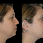 Are Double Chin Removal Results Permanent? Best Doctors in Dubai Respond