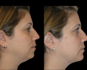 Are Double Chin Removal Results Permanent? Best Doctors in Dubai Respond