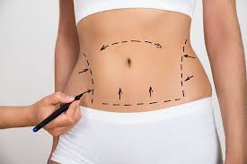 How Liposuction in Dubai Helps Achieve a Slimmer, Defined Figure 1 How Liposuction in Dubai Helps Achieve a Slimmer, Defined Figure
