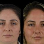 Choosing the Right Specialist for Cheek Fillers Treatment in Dubai