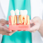 Reclaim Your Smile: A Comprehensive Guide to Dental Implants