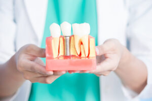 Reclaim Your Smile: A Comprehensive Guide to Dental Implants