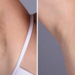 Laser hair removal Treatments in Dubai: Safe, Effective & Approved by Dermatologists