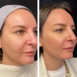 Best Plastic Surgeons in Dubai for Mesotherapy Treatment: Face vs Body Applications