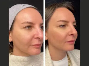 Best Plastic Surgeons in Dubai for Mesotherapy Treatment: Face vs Body Applications