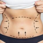 Why Vaser Liposuction in Dubai Is the Preferred Choice for Defined Results