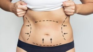 Why Vaser Liposuction in Dubai Is the Preferred Choice for Defined Results