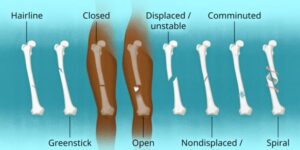 Different Types of Bone Fractures and Their Treatment Options – Orthopedic Trauma & Fracture Care Greater Noida