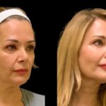 Cheek Fillers by Best Plastic Surgeons in Dubai What Makes Results Natural