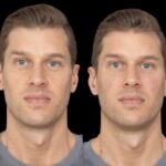 Under Eye Fillers Safety Standards Followed by Best Plastic Surgeons in Dubai