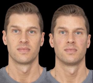 Under Eye Fillers Safety Standards Followed by Best Plastic Surgeons in Dubai