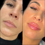 Why the Best Plastic Surgeon in Dubai for Fillers Delivers Natural Results