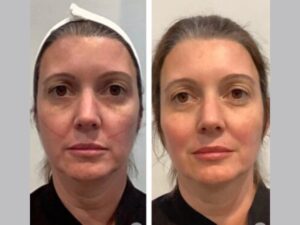 Best Plastic Surgeon in Dubai Redefine Anti-Aging with Thread Lift