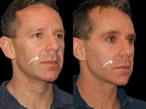 How Men Achieve Symmetry with Sculptra Fillers Treatment in Dubai