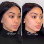 Best Doctors in Dubai for Thread Lift Expert Insights