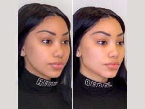 Best Doctors in Dubai for Thread Lift Expert Insights 1 Best Doctors in Dubai for Thread Lift Expert Insights