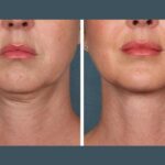 Best Aesthetic Clinics in Dubai for PRP Injections Facial Glow