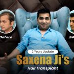 Hair Transplant: What Really Determines Natural-Looking Results
